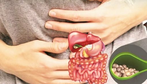 Gallstones پتے کی پتھری - Image 2
