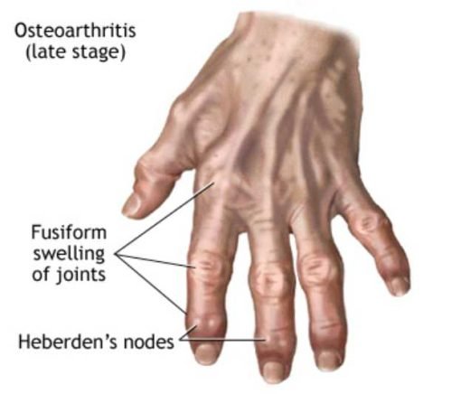 Arthritis Joint Pain گنٹھیا جوڑوں کا درد - Image 6