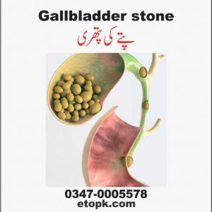 GallBladder GallStones پتے کی پتھری 1