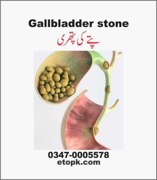 Gallstones پتے کی پتھری