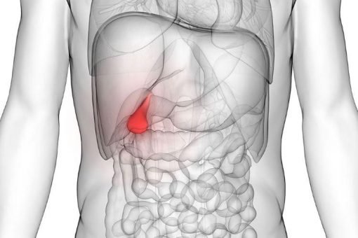 Gallstones پتے کی پتھری - Image 3