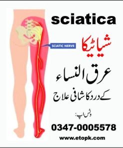 عرق النساء شیاٹیکا