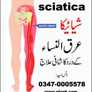 Sciatica Arq ul Nisa عرق النساء شیاٹیکا کا درد 0