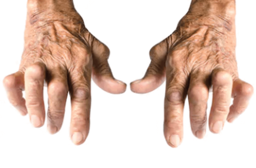 Arthritis Joint Pain گنٹھیا جوڑوں کا درد - Image 3