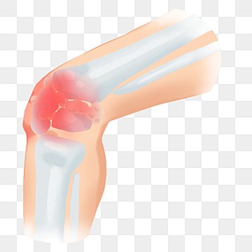 pngtree-knee-arthritis-pain-image_2251915