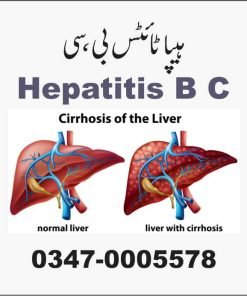 کالا یرقان