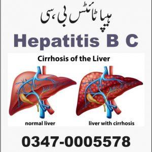 Hepatitis B C کالا یرقان