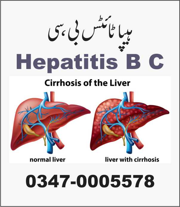 Hepatitis B C کالا یرقان