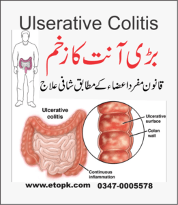 السریٹو کولائٹس بڑی آنت کا زخم