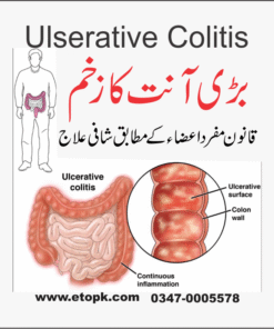 السریٹو کولائٹس بڑی آنت کا زخم